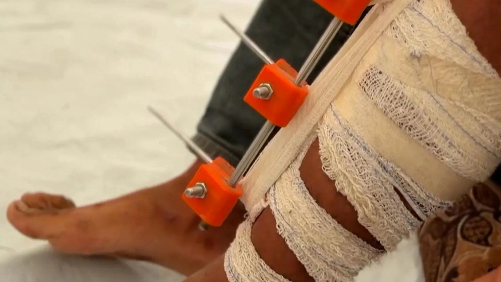Gaza Physicians Innovate with 3D-Printed Devices to Prevent Amputations