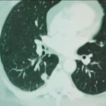 AI Innovations in Cancer Detection: What Researchers Are Discovering