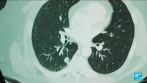 AI Innovations in Cancer Detection: What Researchers Are Discovering