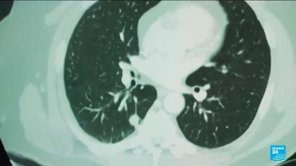 AI Innovations in Cancer Detection: What Researchers Are Discovering